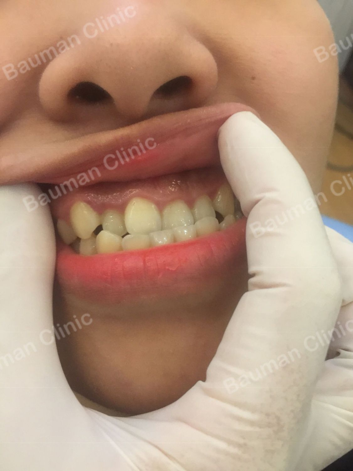Ca niềng răng số 5052 - Nha khoa Bauman Clinic