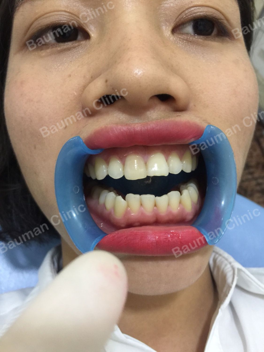 Ca niềng răng số 5056 - Nha khoa Bauman Clinic