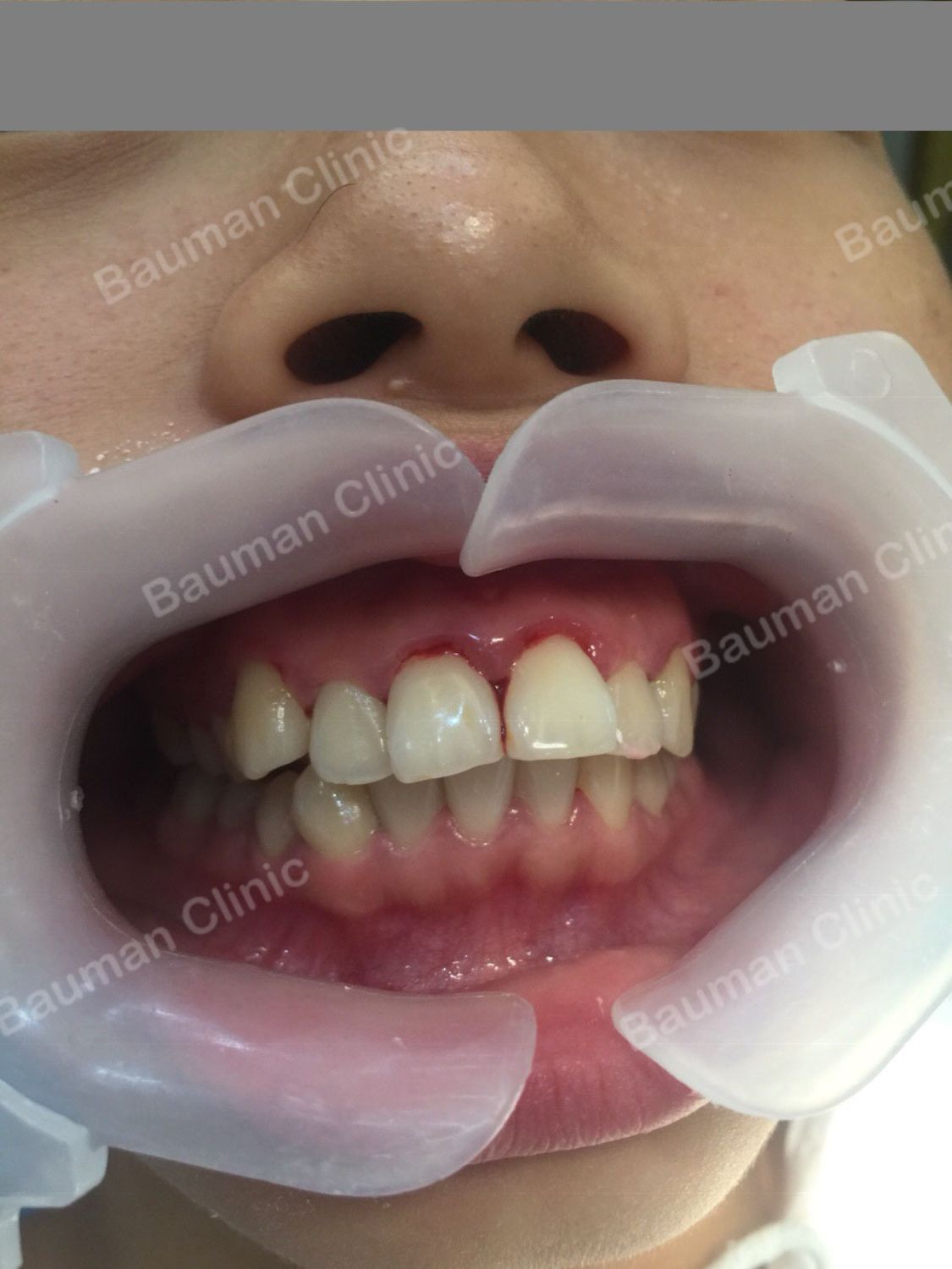Ca niềng răng số 5068 - Nha khoa Bauman Clinic