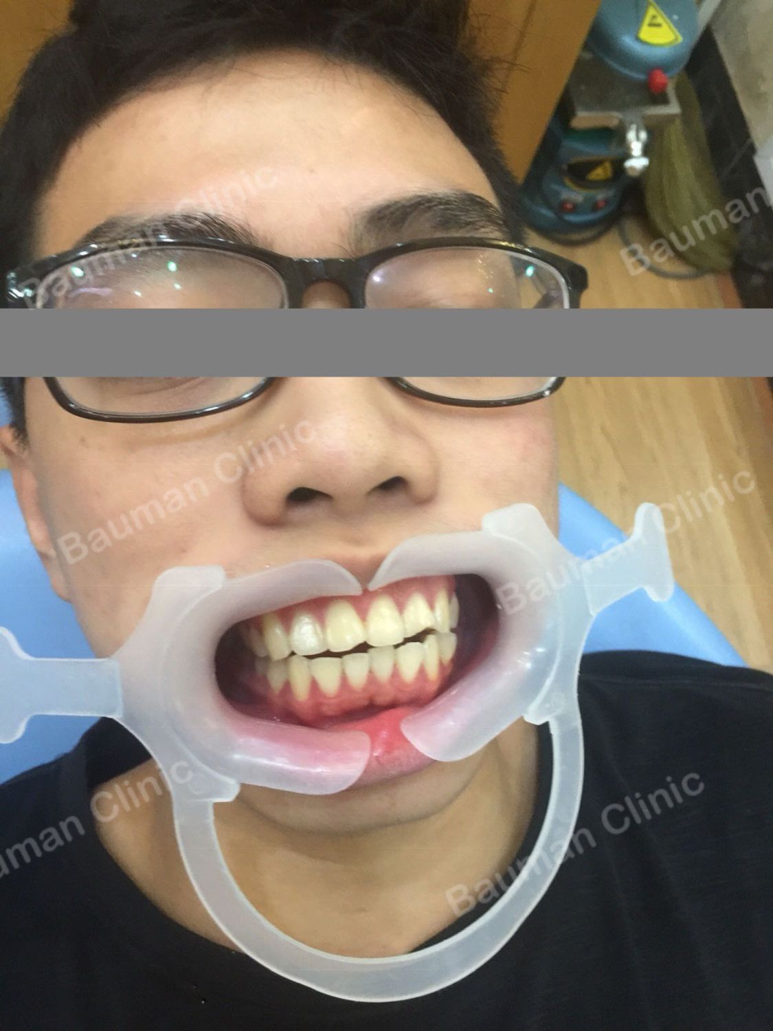 Ca niềng răng số 5070 - Nha khoa Bauman Clinic