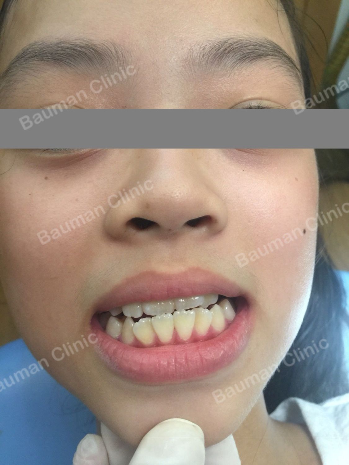 Ca niềng răng số 5072 - Nha khoa Bauman Clinic