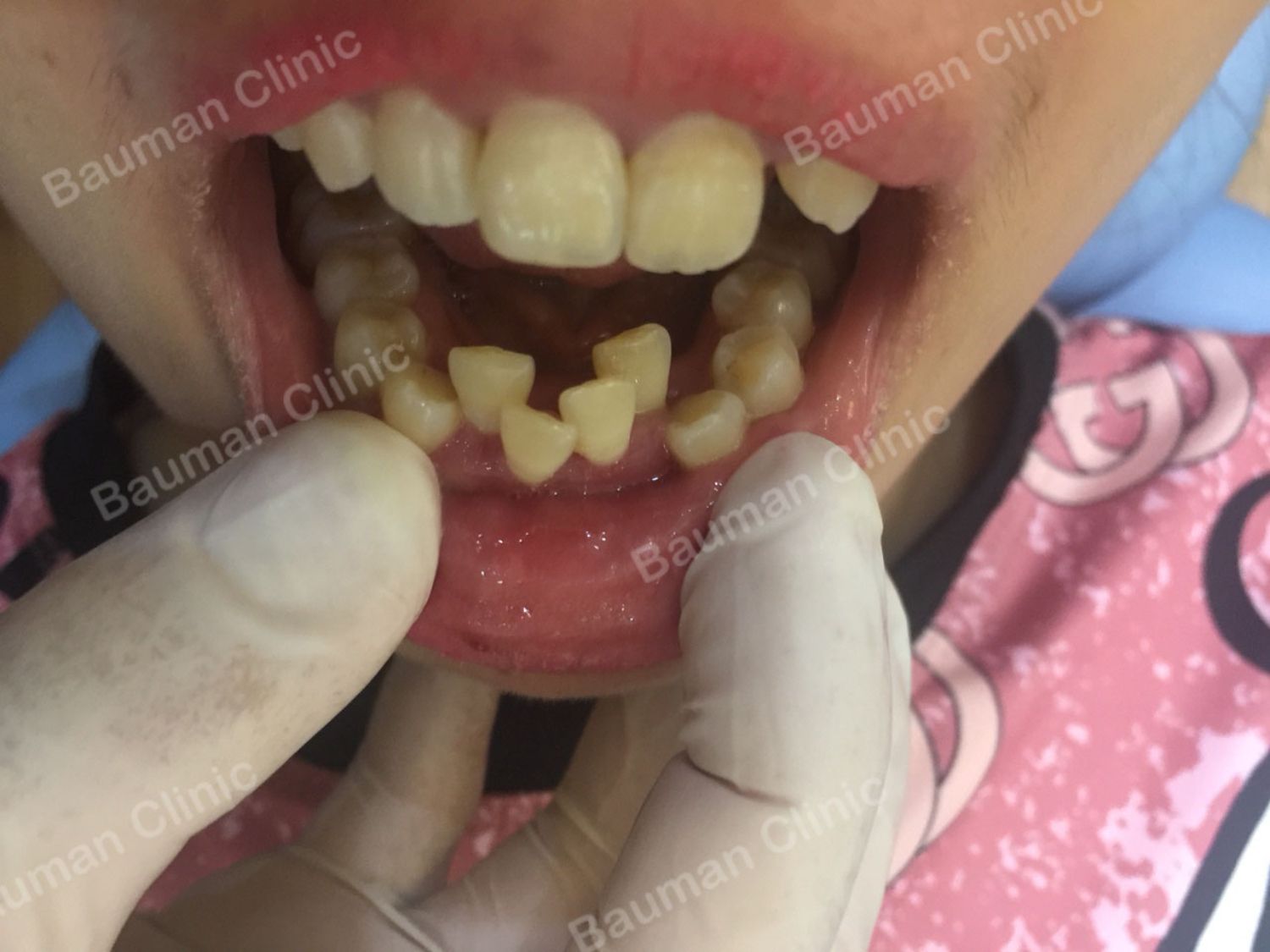 Ca niềng răng số 5073 - Nha khoa Bauman Clinic