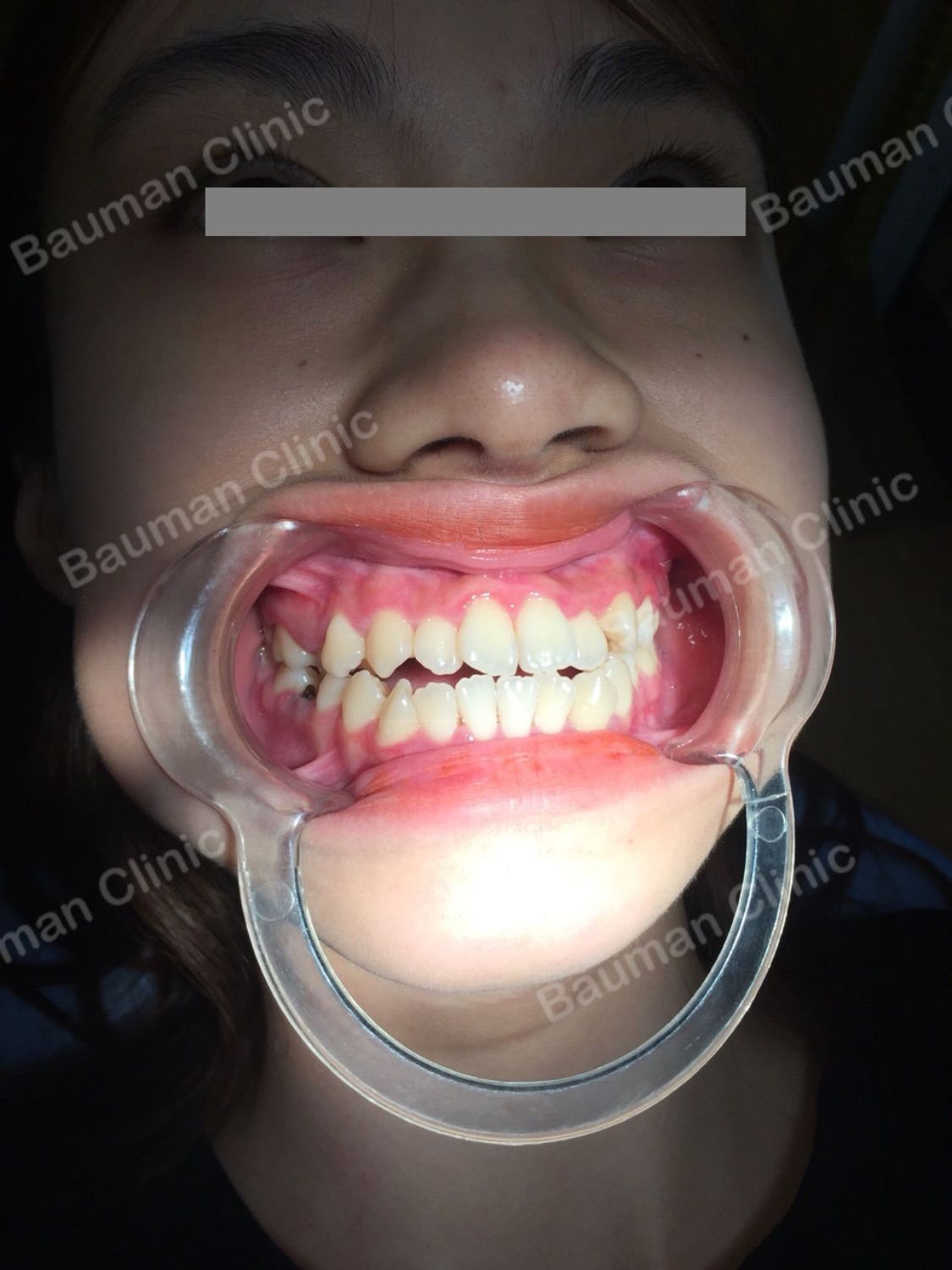 Ca niềng răng số 5074 - Nha khoa Bauman Clinic