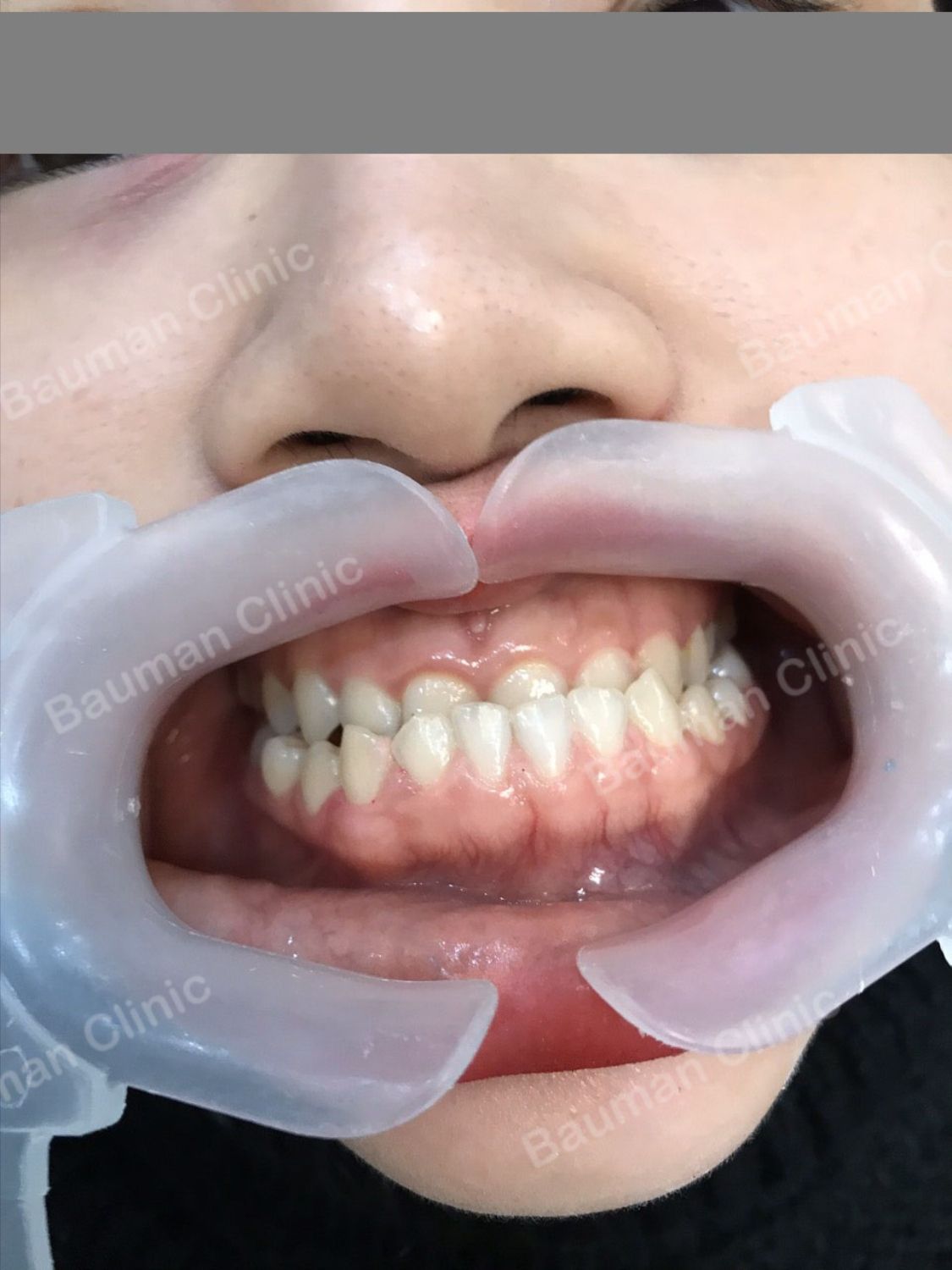 Ca niềng răng số 5087 - Nha khoa Bauman Clinic