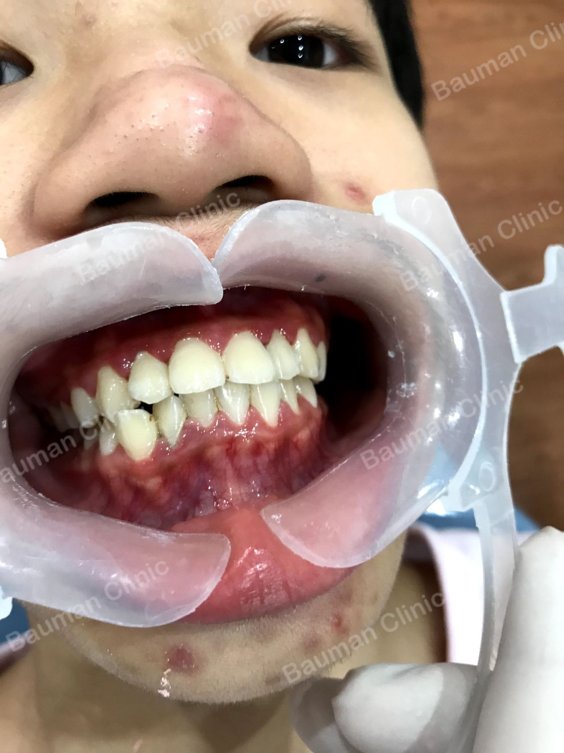 Ca niềng răng số 5020 - Nha khoa Bauman Clinic