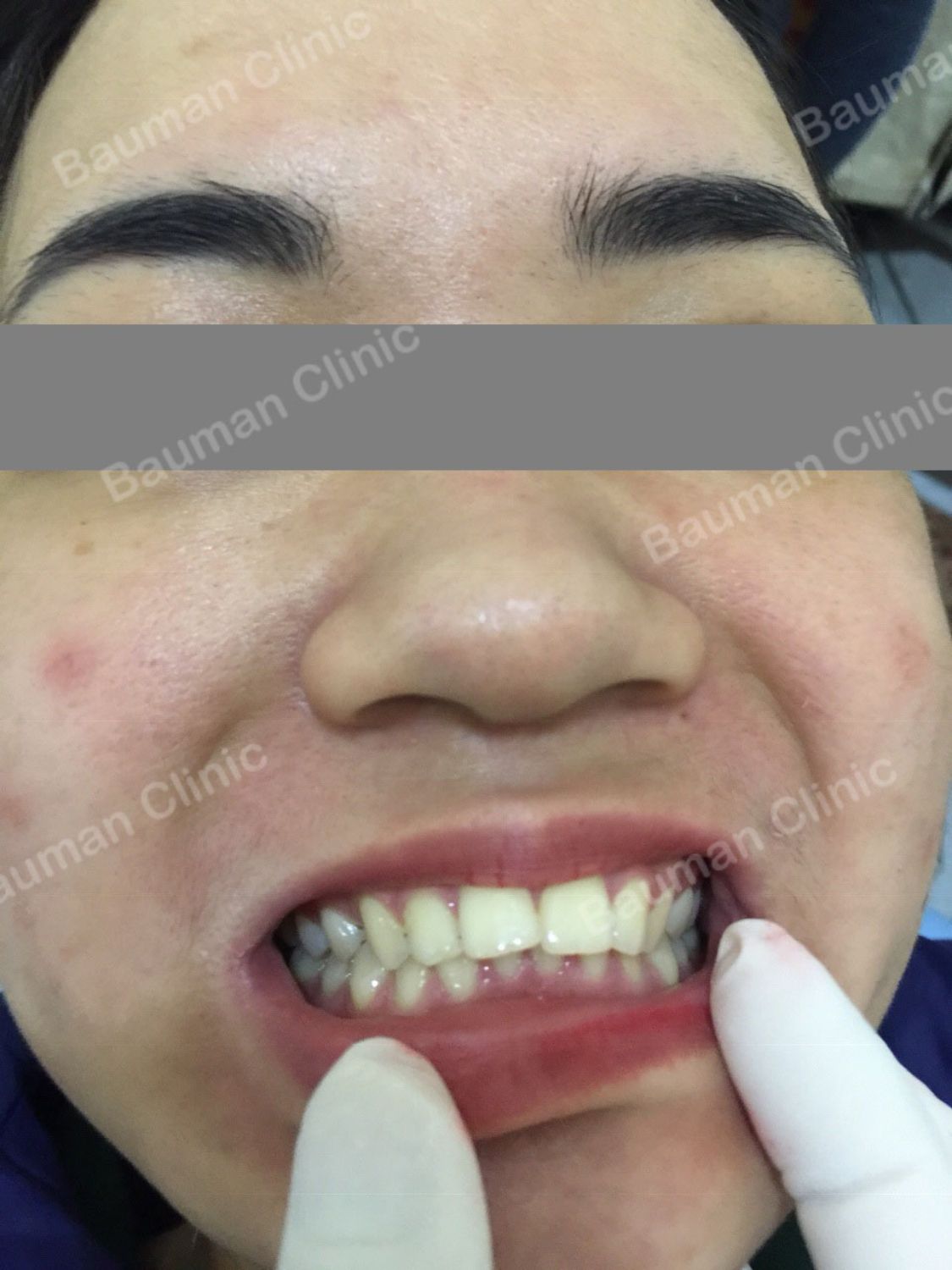 Ca niềng răng số 5031 - Nha khoa Bauman Clinic