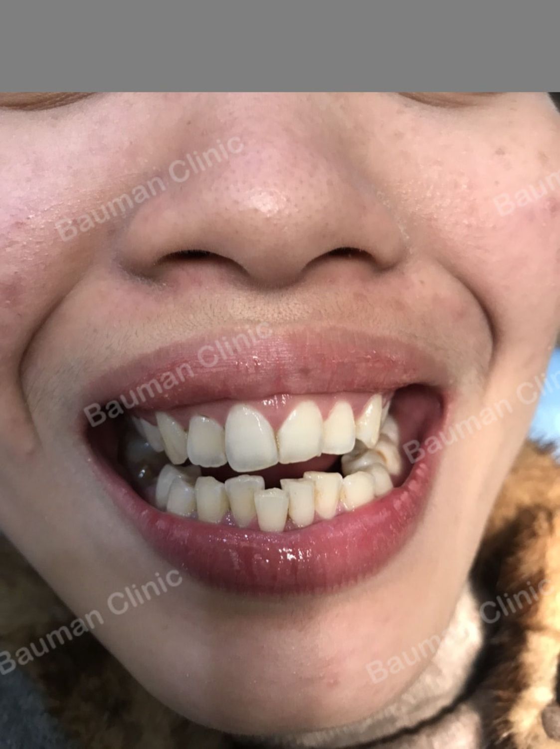 Ca niềng răng số 5089 - Nha khoa Bauman Clinic