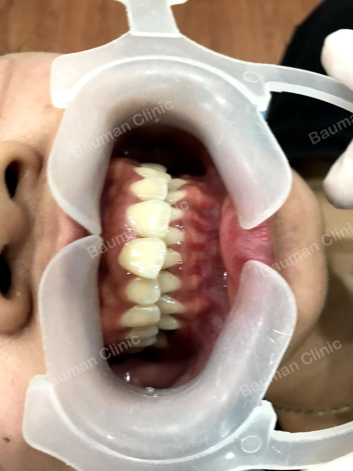 Ca niềng răng số 5022 - Nha khoa Bauman Clinic