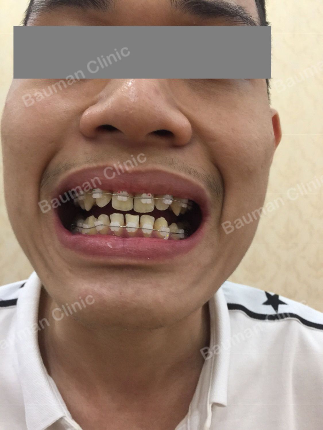 Ca niềng răng số 5033 - Nha khoa Bauman Clinic