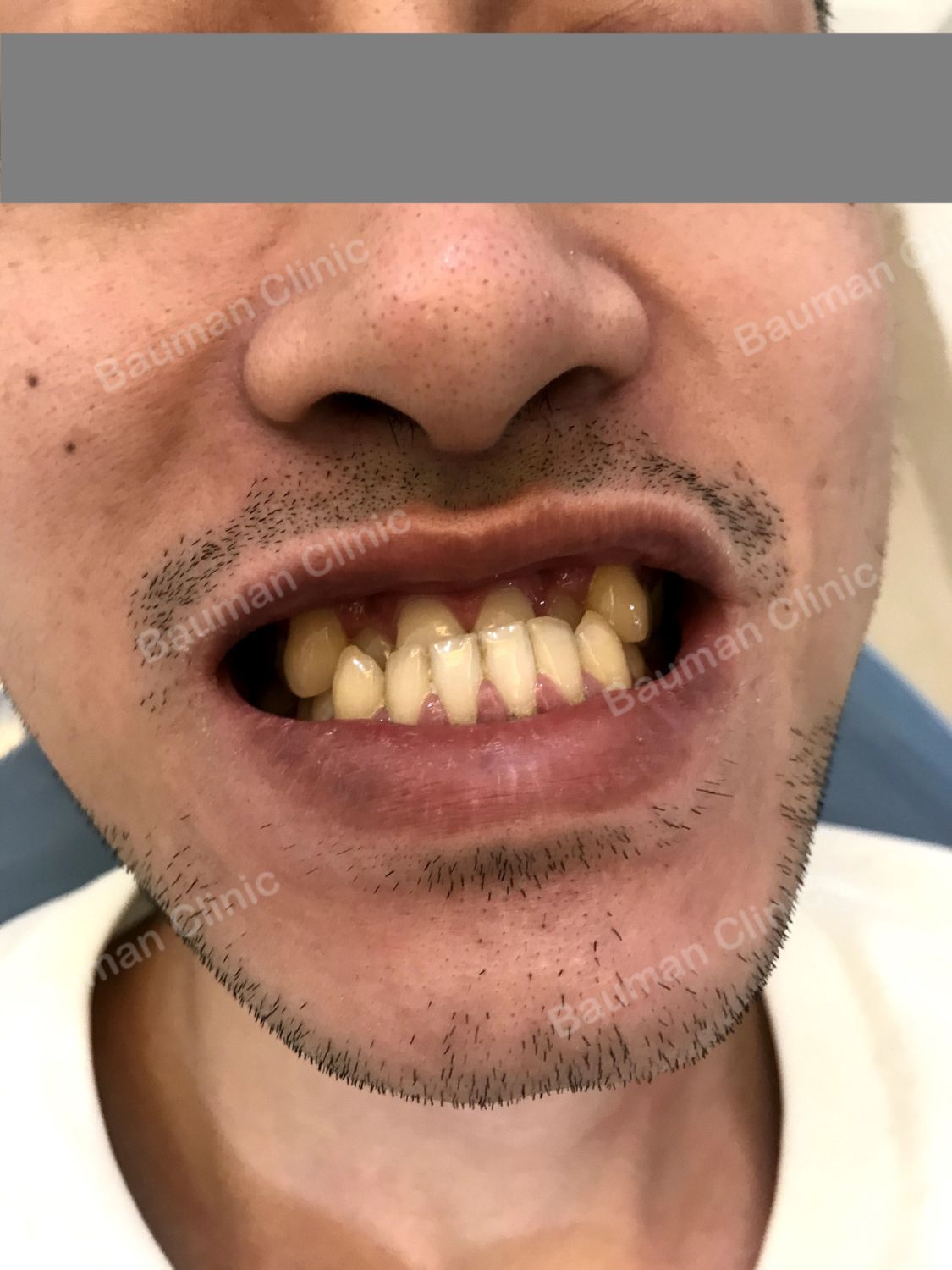 Ca niềng răng số 5023 - Nha khoa Bauman Clinic