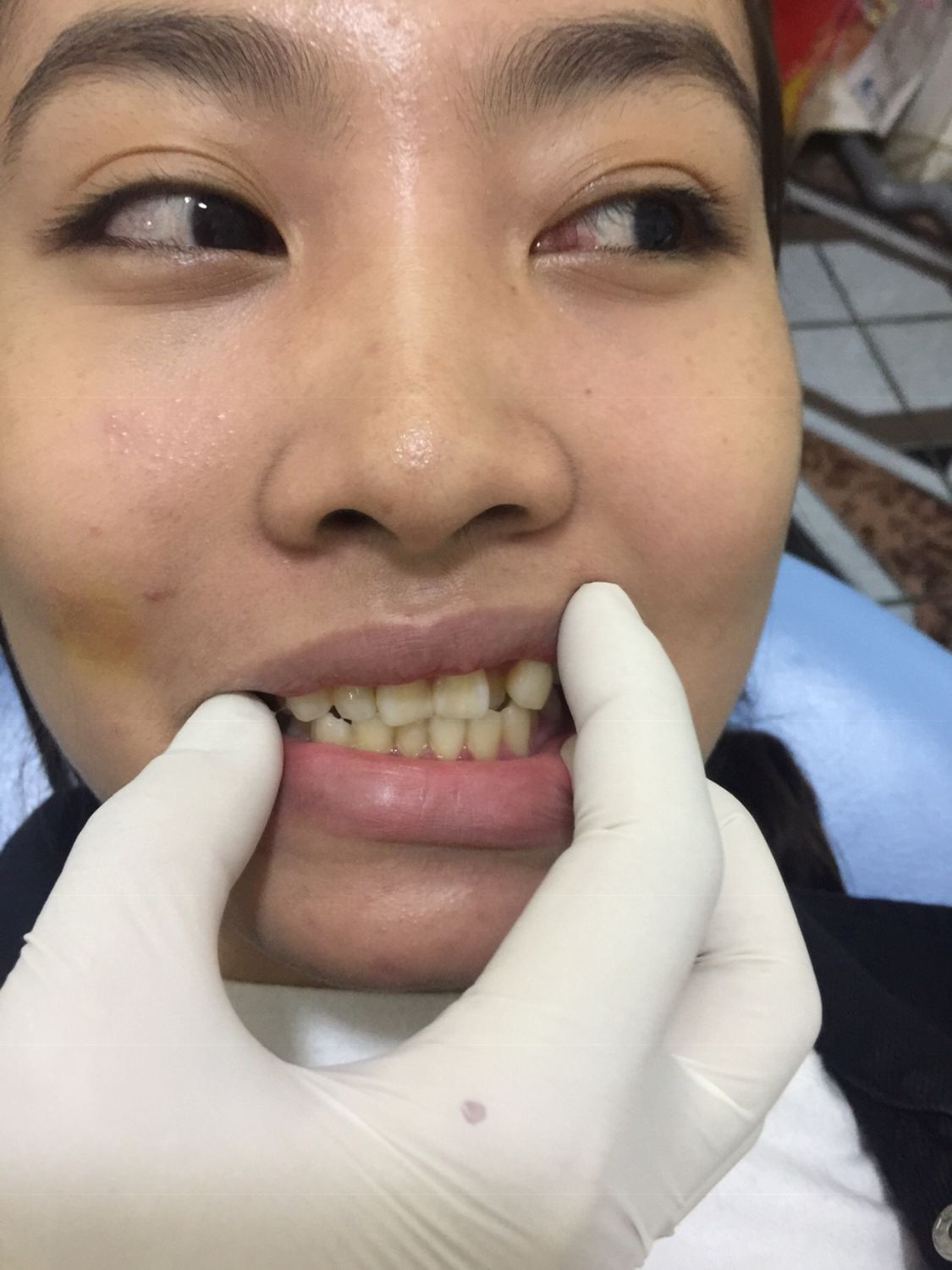 Ca niềng răng số 5041 - Nha khoa Bauman Clinic