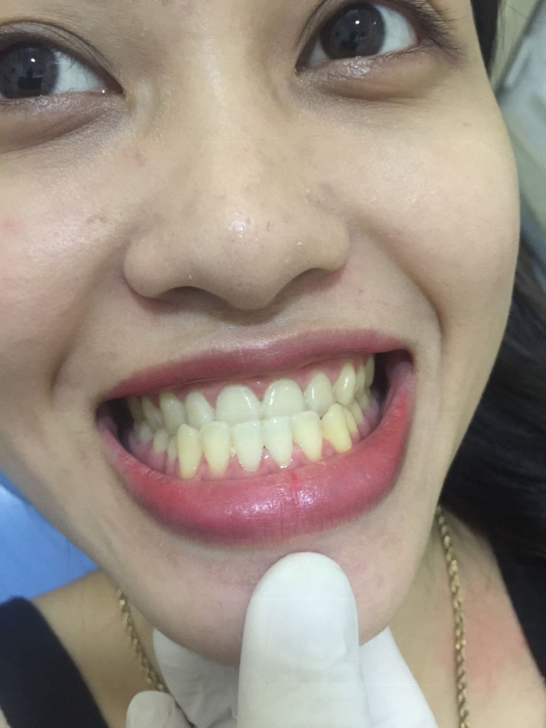 Ca niềng răng số 5043 - Nha khoa Bauman Clinic