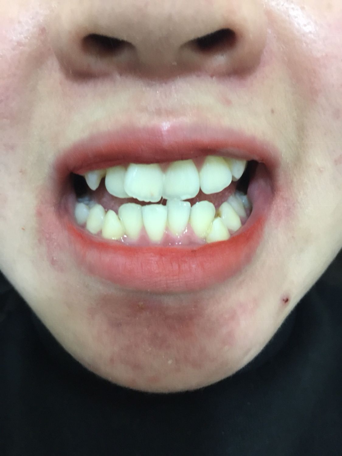 Ca niềng răng số 5044- Nha khoa Bauman Clinic