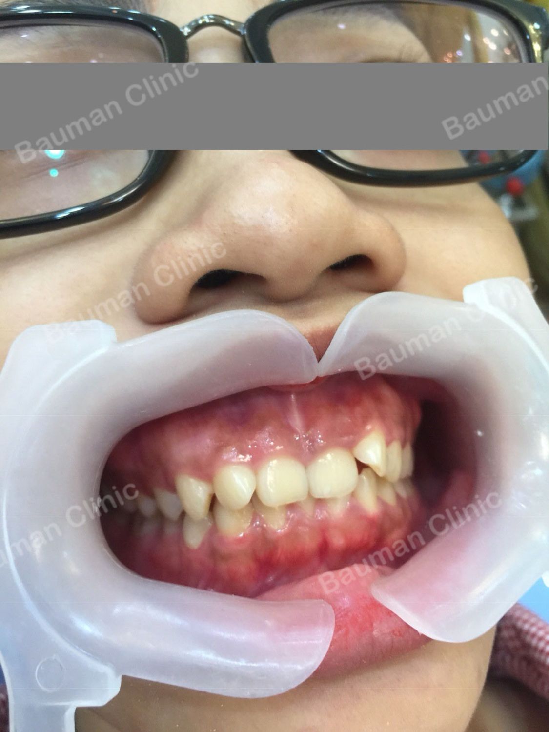 Ca niềng răng số 5047 - Nha khoa Bauman Clinic