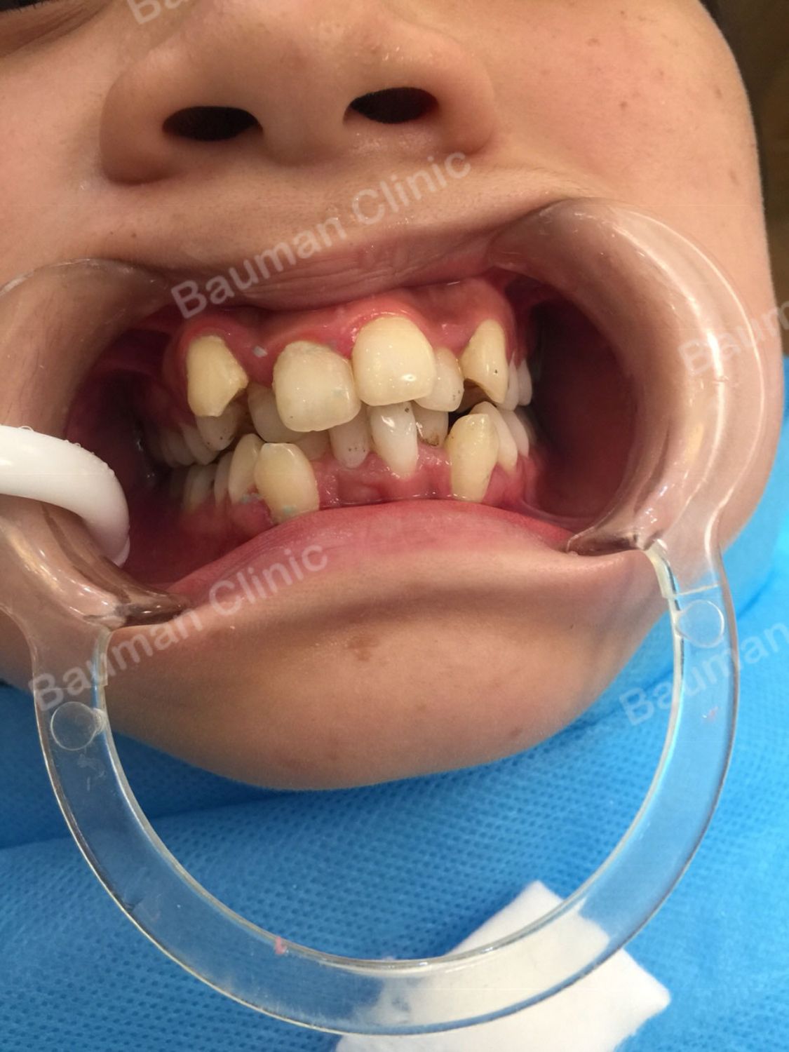 Ca niềng răng số 5048 - Nha khoa Bauman Clinic