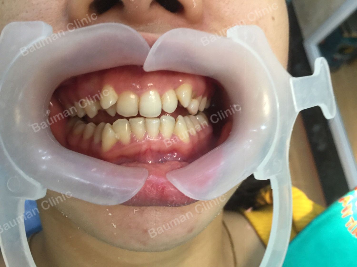 Ca niềng răng số 5049 - Nha khoa Bauman Clinic