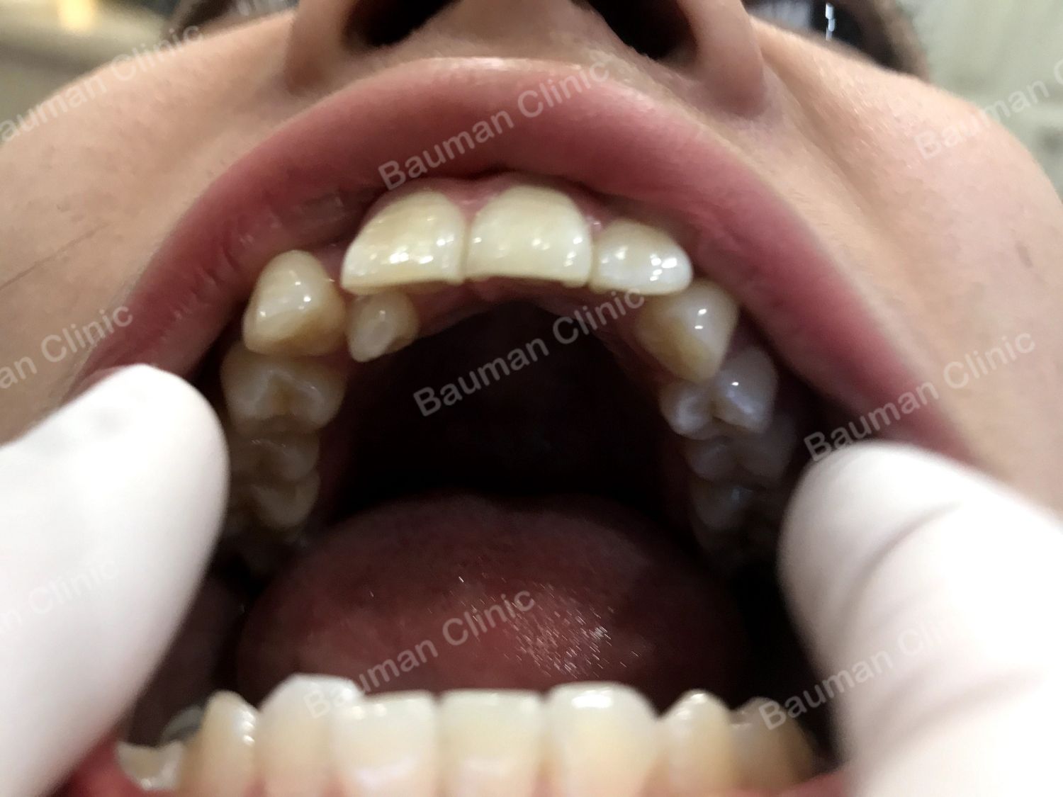 Ca niềng răng số 5021 - Nha khoa Bauman Clinic