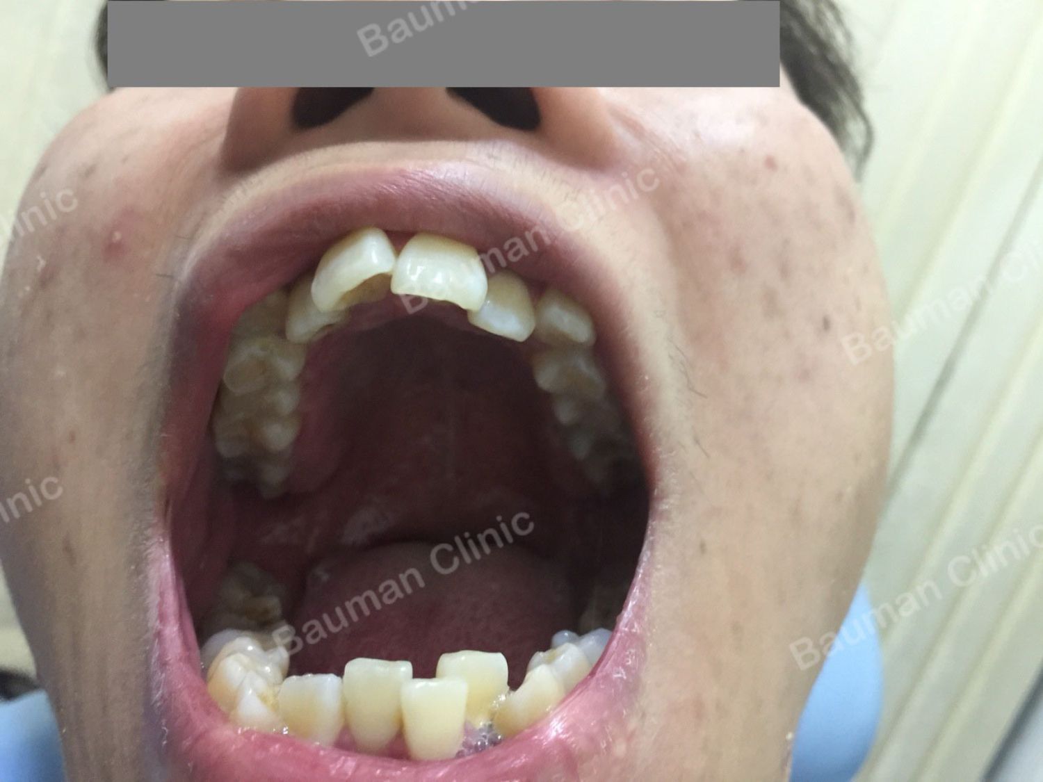 Ca niềng răng số 5032 - Nha khoa Bauman Clinic