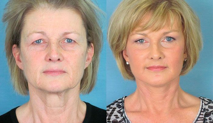 Căng da mặt- Dr Huệ