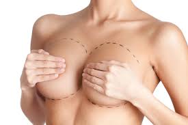 Quá trình hồi phục và kết quả sau nâng ngực bằng túi độn-Dr Huệ