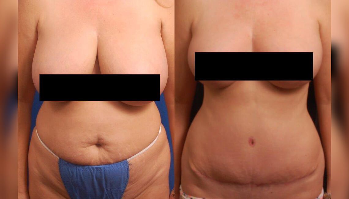 Combo ngực bụng Mommy Makeover- Dr Huệ