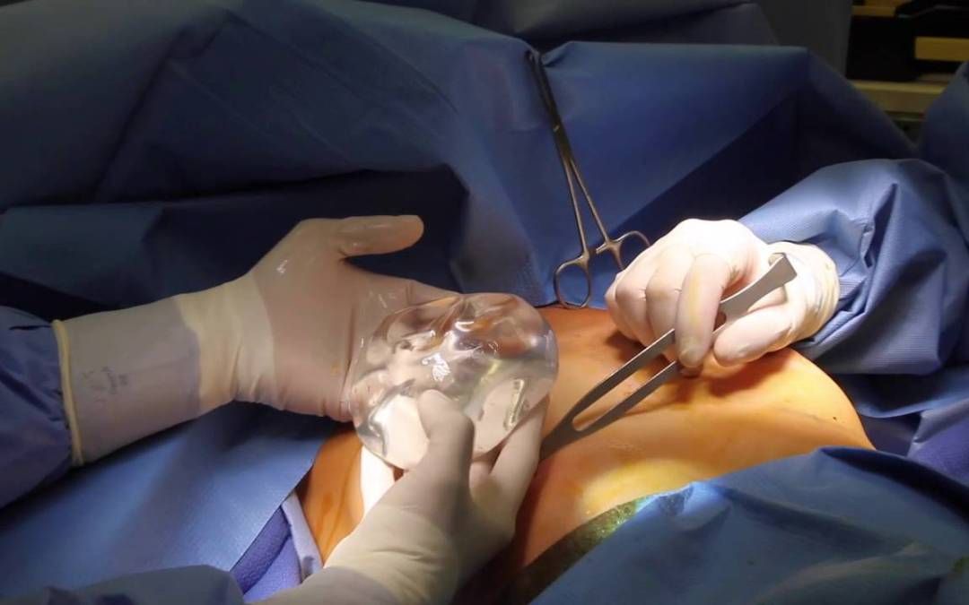 Quy trình phẫu thuật nâng ngực bằng túi độn- Dr Huệ