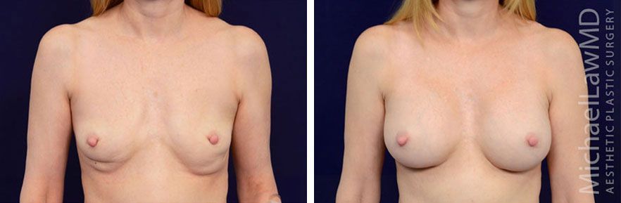 Chỉnh sửa ngực hỏng, ngực lỗi - Thẩm mỹ Bauman Clinic