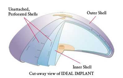 Túi nước muối Ideal Implant - Thẩm mỹ Bauman Clinic