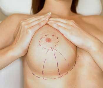 Những câu hỏi thường gặp về phẫu thuật thu gọn ngực