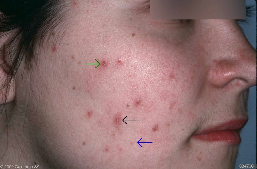 Mụn trứng cá là gì?