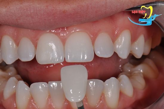 Phương pháp chỉnh răng móm hiệu quả bằng bọc sứ