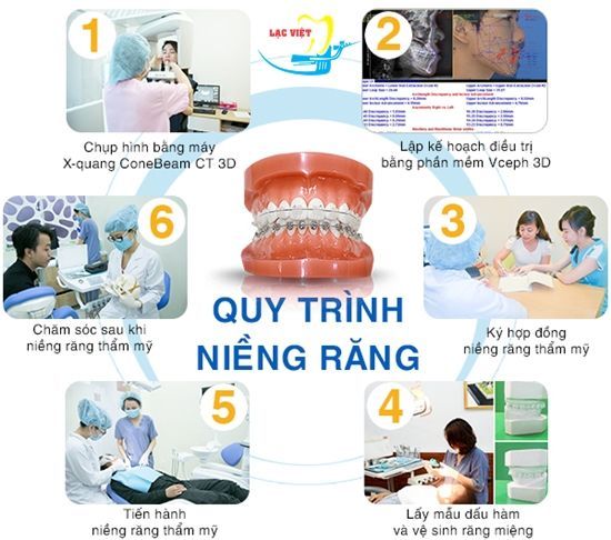 Quy trình niềng 2 răng khểnh