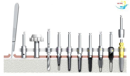 Các bước cắm trụ implant vào xương hàm