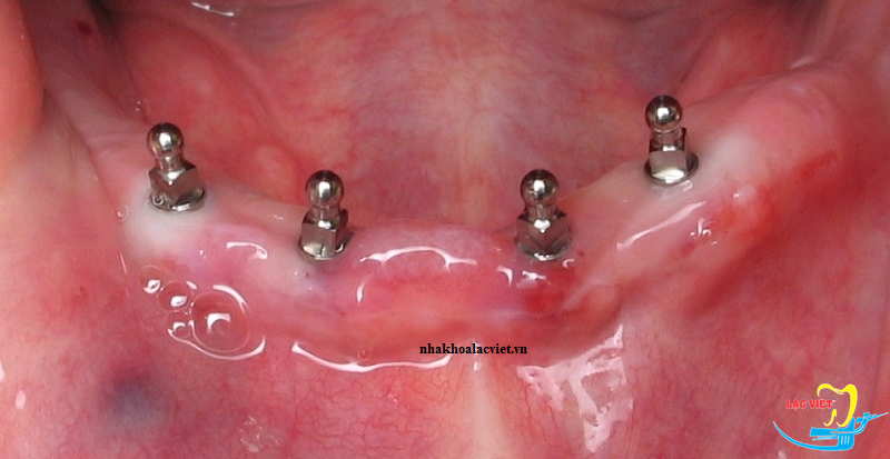 Cấy ghép mini implant