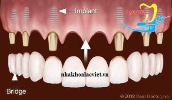 Làm cầu răng sứ trên implant mang lại hiệu quả cao