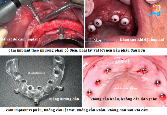 Cắm ghép implant bằng cách vi phẩu không đau