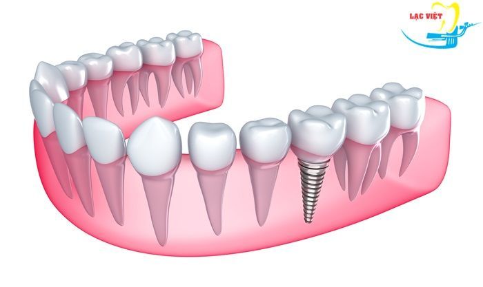 Cấu tạo của răng implant.