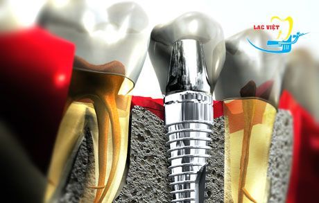 Trồng răng Implant ở đâu tốt nhất tại Hà Nội? Nha khoa Lạc Việt