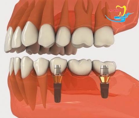 Làm răng implant không đau tại nha khoa Lạc Việt
