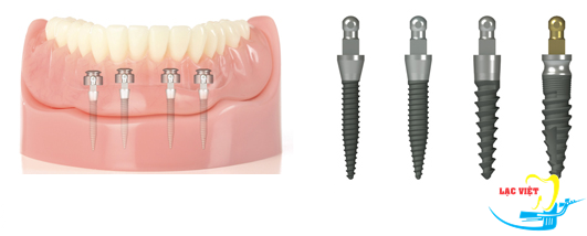 Cấy ghép mini implant loại 1 khối