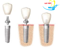 cấy ghép mini implant loại 2 khối