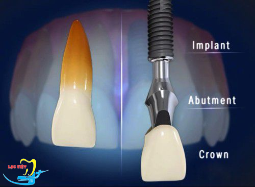 Cấu tạo implant nha khoa