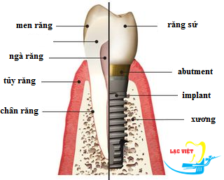 Cấy tạo của răng implant