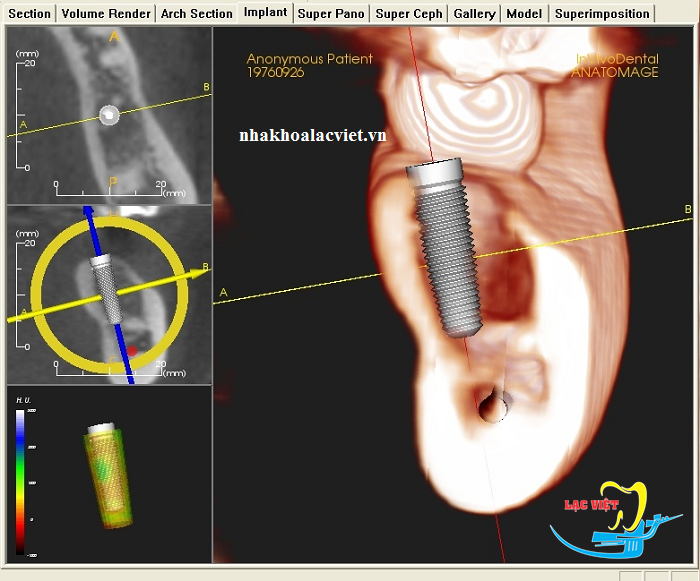 Phân tích phim trước khi tiến hành cấy ghép răng implant