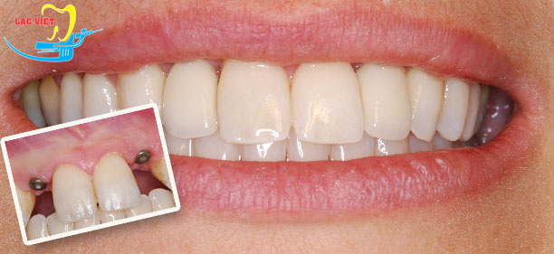 cấy răng implant ở Hà Nội - kết quả phục hình