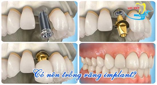 Có nên trồng răng bằng phương pháp cấy Implant? - Nha khoa Lạc Việt