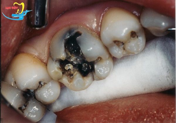 Nguyên nhân khác gây đau răng hàm dưới bên trái ngoài sâu răng là gì?
