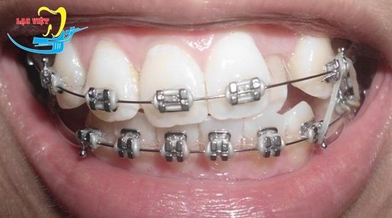 răng khểnh là đẹp hay xấu và giải pháp khắc phục
