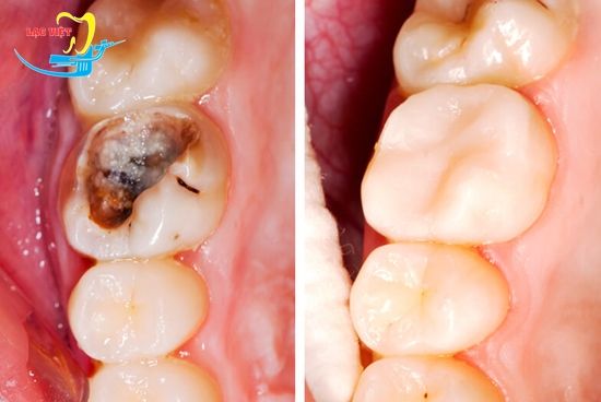 Dấu hiệu và triệu chứng phổ biến của sâu răng bạn nên biết