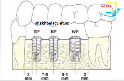 Bản vẻ cấu trúc răng implant tồn tại suốt đời